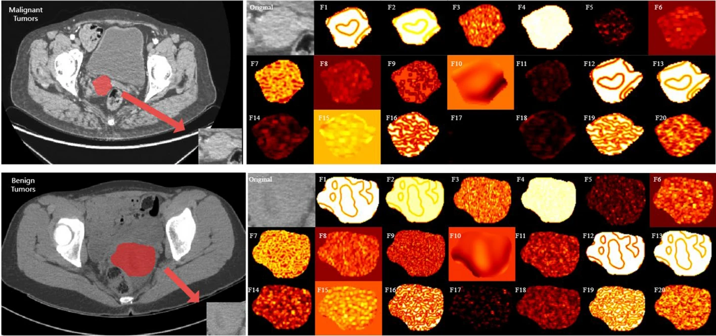 Endometrial Cancer ML Overview